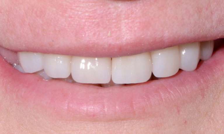 Smile-Makeover-From-Tooth-Damage-After-Image