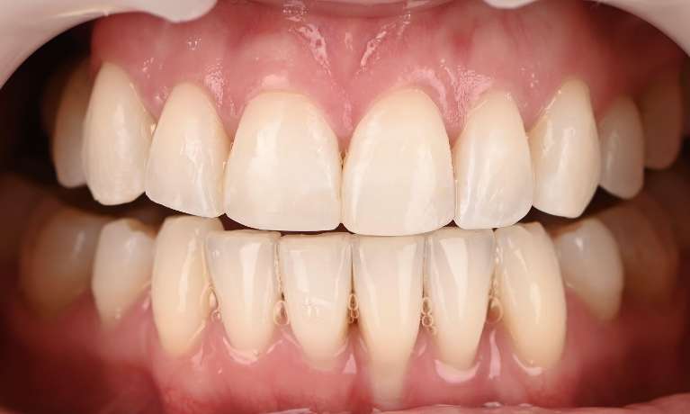 Smile-Makeover-with-Dental-Implants-After-Image