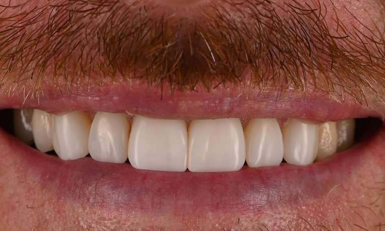 Smile-Makeover-Align-Bleach-Bond-After-Image