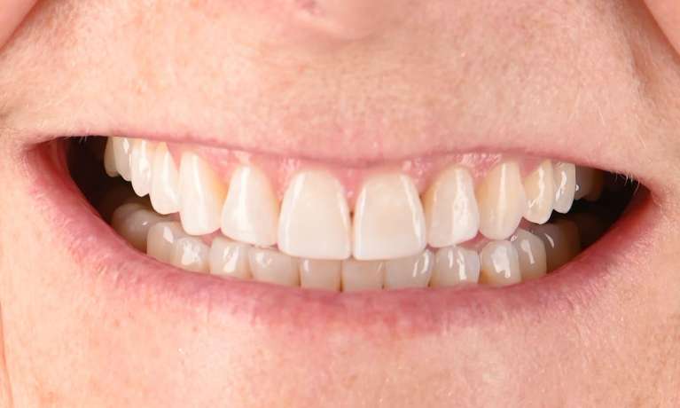 Smile-Makeover-After-Image