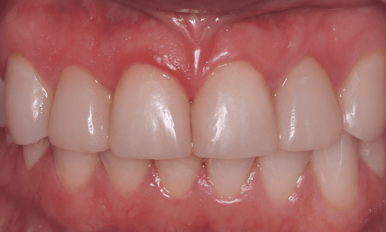 front teeth after veneers