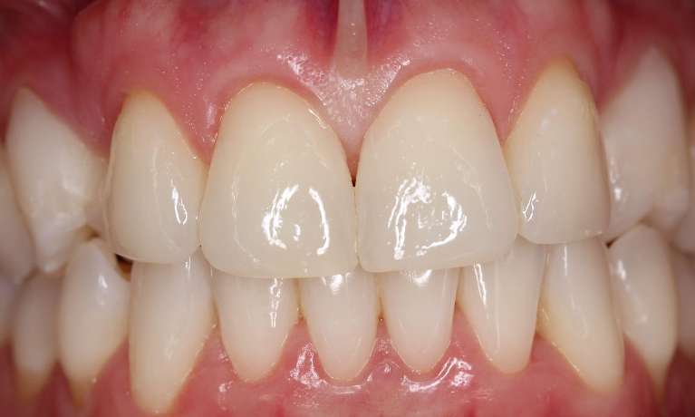 brith front teeth after whitening and bonding