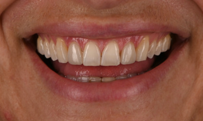 smile after composite resin veneers