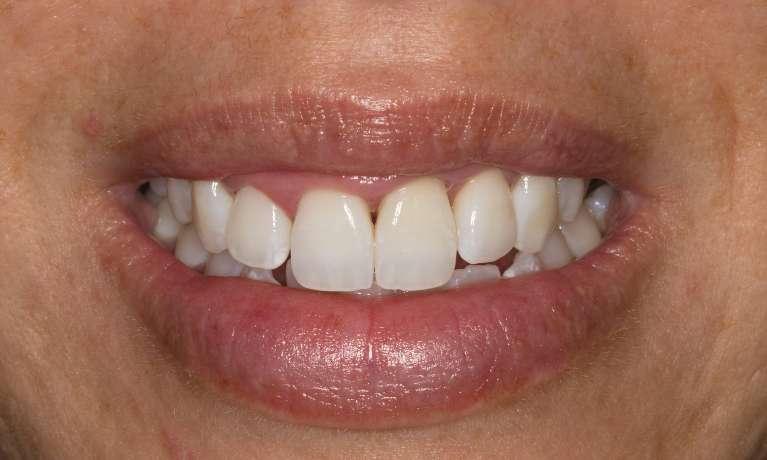 front teeth after whitening