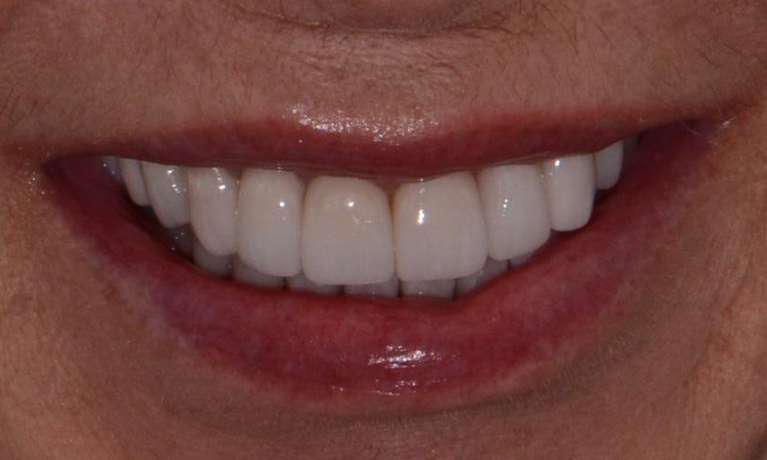 new bright smile after crowns and veneers