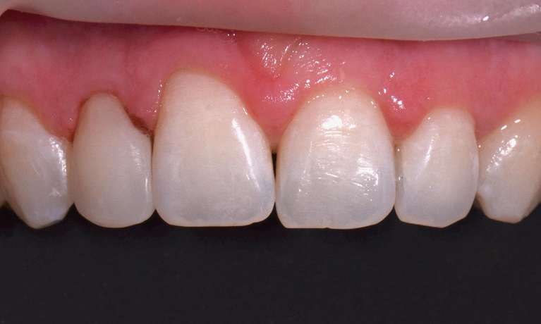new veneer result