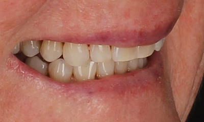 Invisalign After