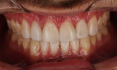 After treatment - Clear Aligners, with Composite Veneers