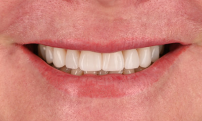 teeth after whitening and veneers