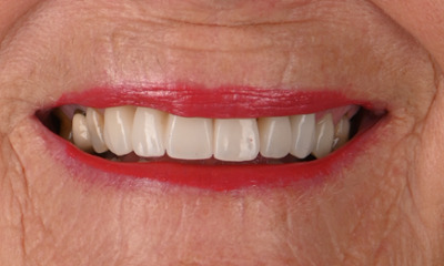 after front tooth crown