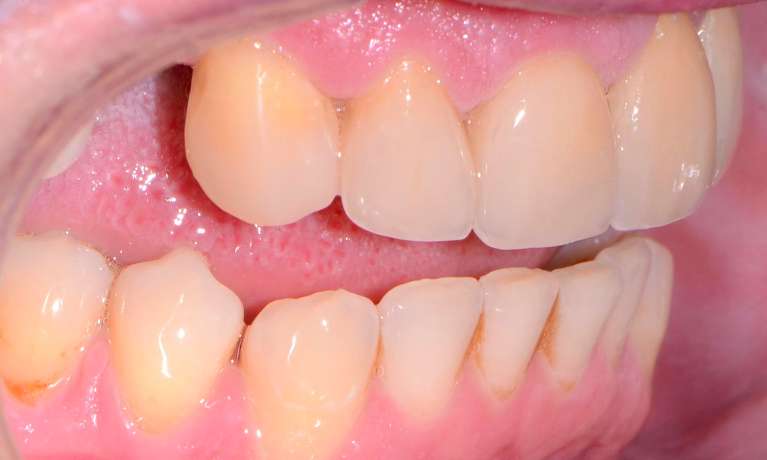 crowns and veneers after photo warners bay