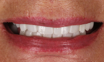 Partial Dentures After
