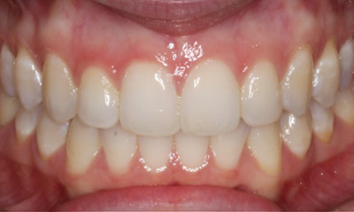 bright, straight smile after invisalign treatment and bonding