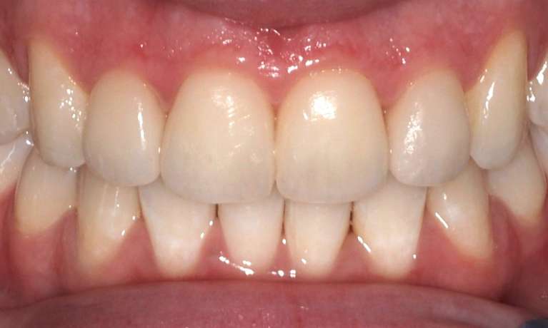 Smile after clear aligners 