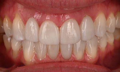 new bright results after Invisalign and veneers
