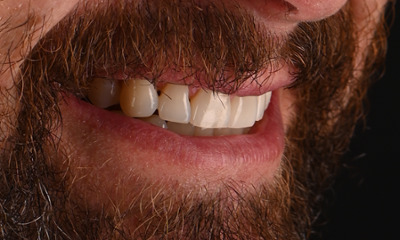 straight smile after Invisalign, whitening