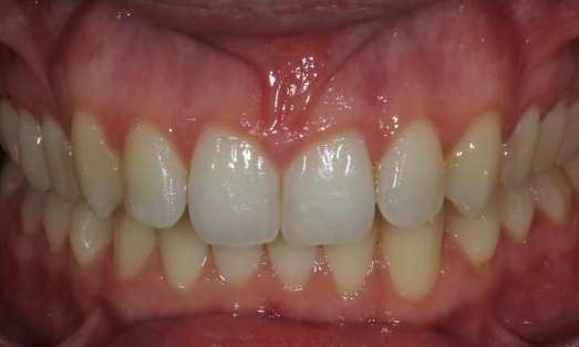 smile after invisalign 