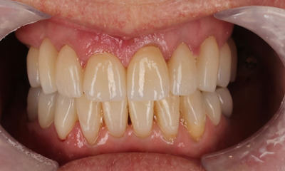 After treatment - Porcelain Crowns and Bridges Transformation