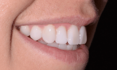 bright front teeth after dental veneers