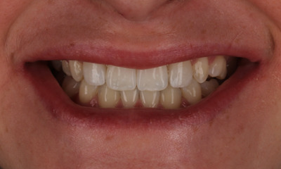 close up of smile after veneers and orthodontics