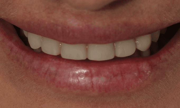 front teeth after veneers