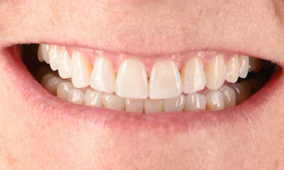 bright front teeth after smile makeover in warners bay