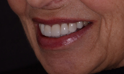 new bright smile after crowns and veneers