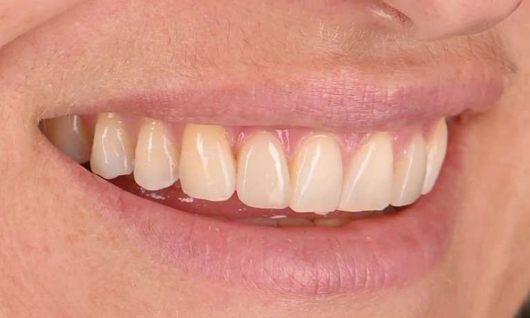 straight smile after veneers and whitening