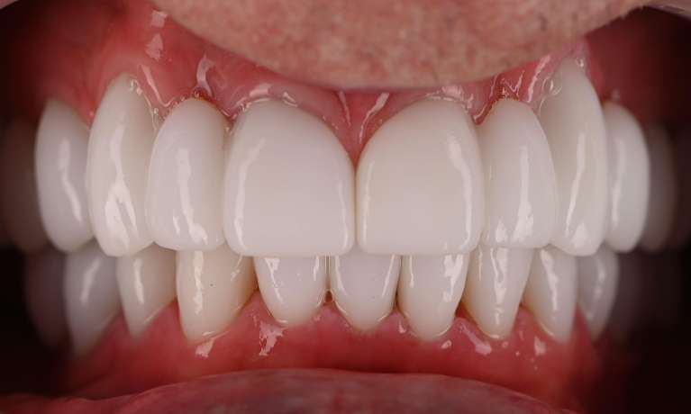 new crowns and fillings used to transform this patient's smile
