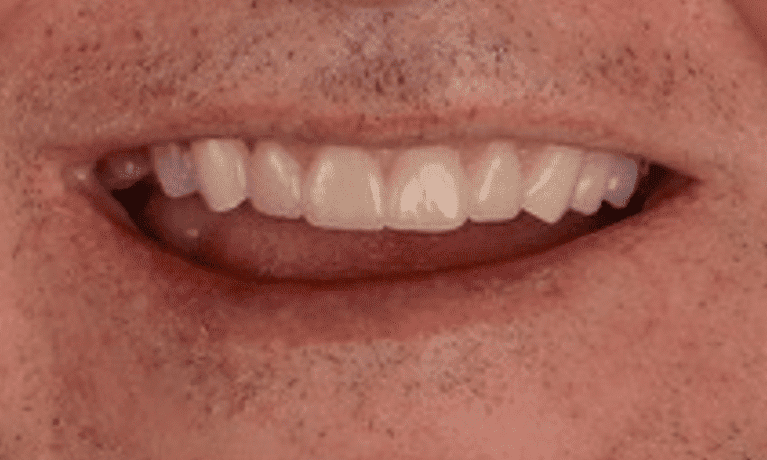 after photo of full smile rehabilitation in warners bay