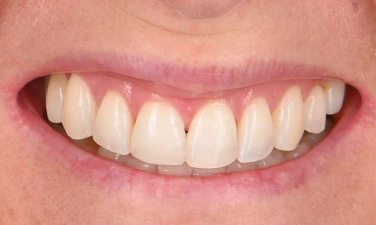 smile makeover after dental implants, Invisalign and dental bonding
