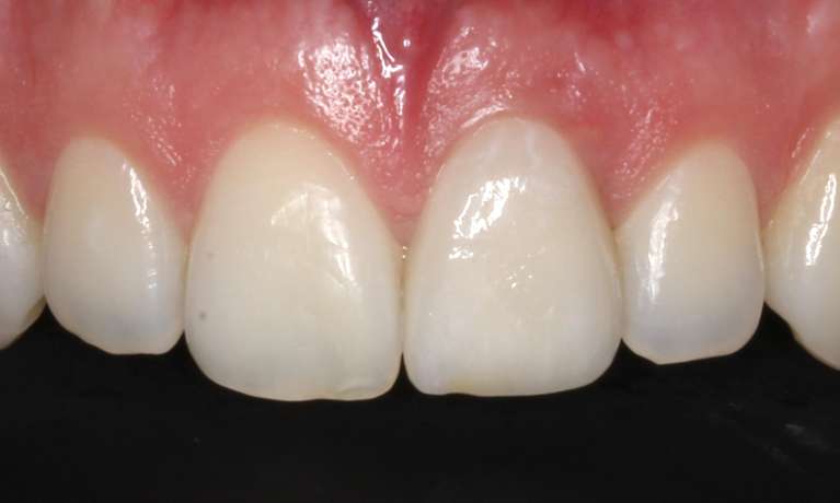 patient after missing tooth is replaced with dental implant