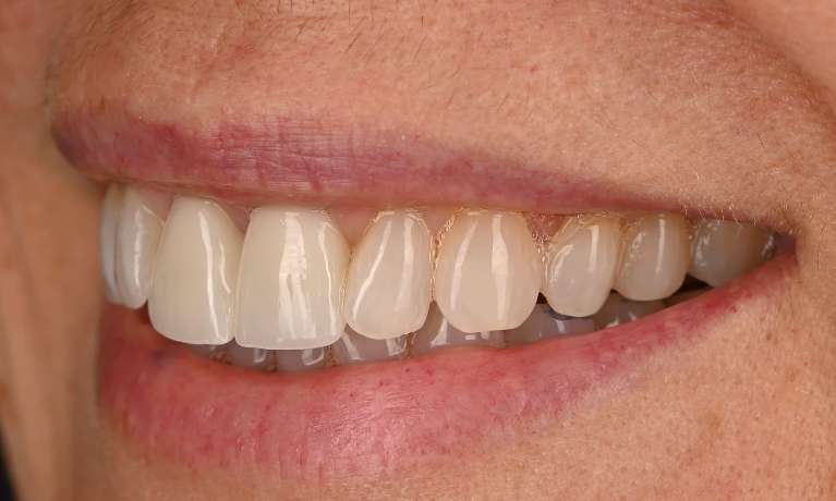 smile with teeth whitening and new crowns 