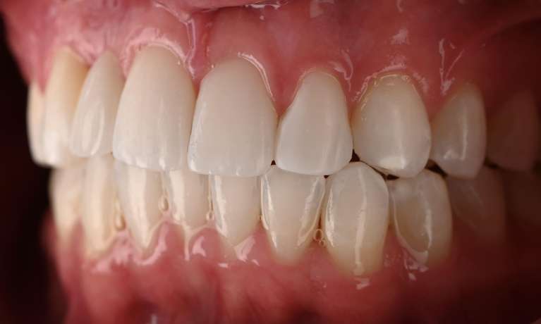 Post Ortho Update with Whitening Veneers After 2