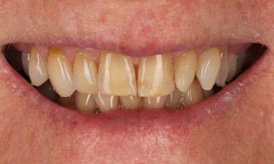 Before treatment - Clear Aligners Transformation with Teeth Whitening