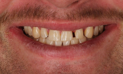Before treatment - Clear Aligners, with Composite Veneers