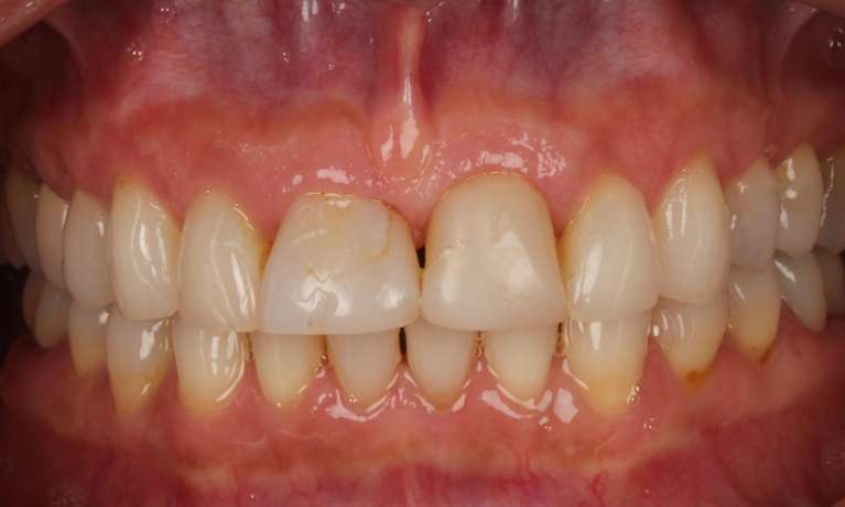 smile Before composite bonding and whitening