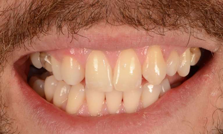 front teeth before composite bonding