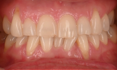 teeth before whitening and veneers