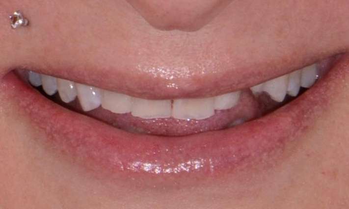 patient's uneven smile before whitening and veneers
