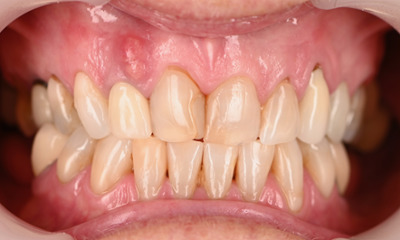 front tooth with broken root