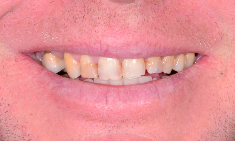 patient before getting new crows and veneers in warners bay