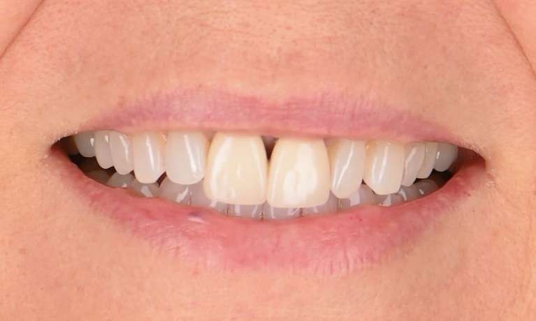 slight gap in front teeth