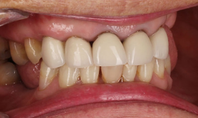 Before treatment - Dental Crowns Replacement and Partial Dentures