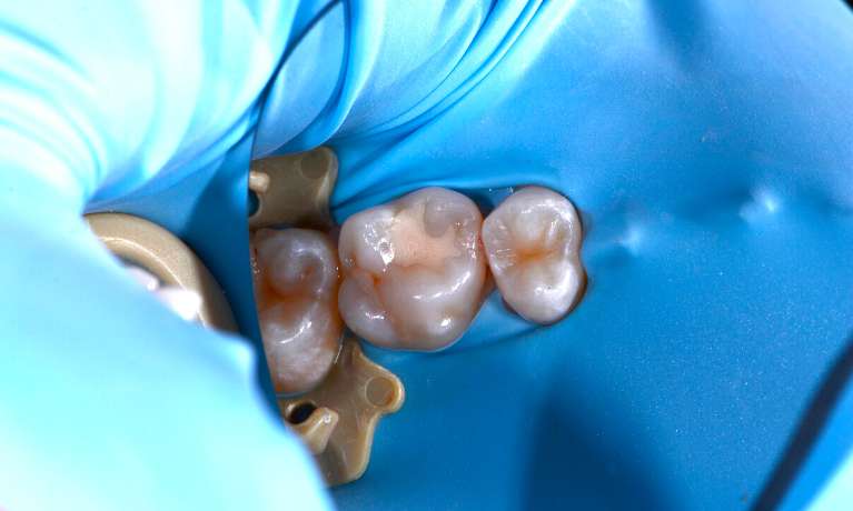 Dental-Fillings-on-Back-Tooth-Before-Image