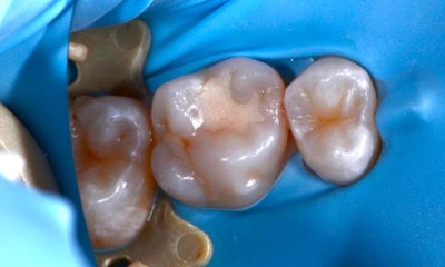 Dental-Fillings-on-Back-Tooth-Before-Image