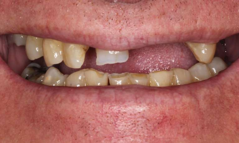 Full-Arch-Dental-Implant-Before-Image