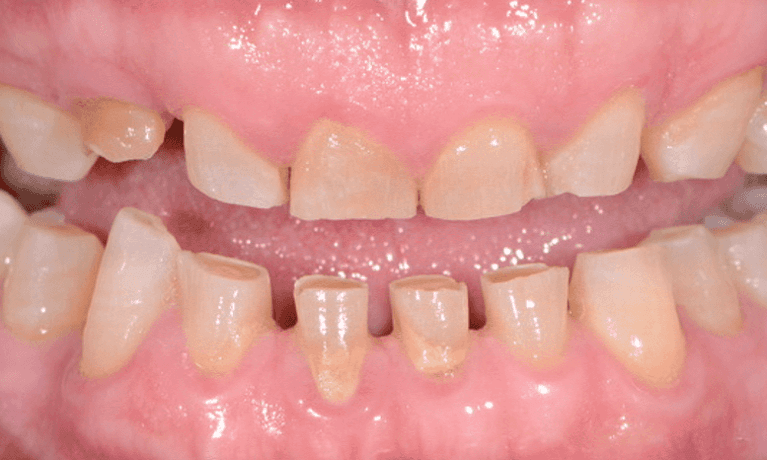 patient before full mouth rehabilitation in warners bay