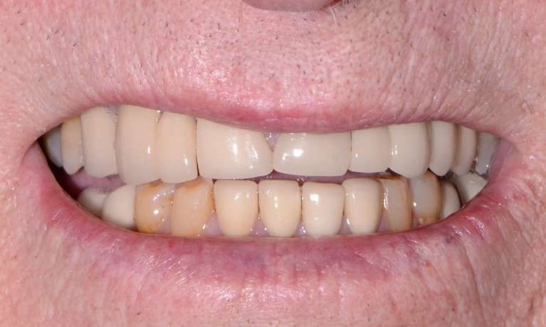 Full-Mouth-Rehabilitation-Before-Image