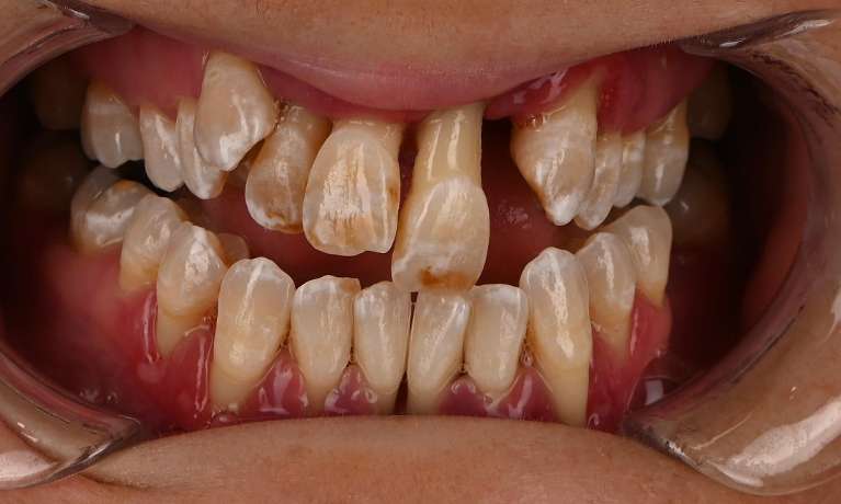 Full-Smile-Rehabilitation-Before-Image